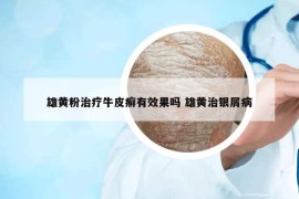 雄黄粉治疗牛皮癣有效果吗 雄黄治银屑病