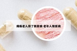 瘫痪老人得了银屑病 老年人银屑病