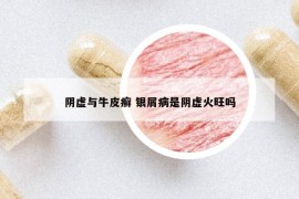阴虚与牛皮癣 银屑病是阴虚火旺吗