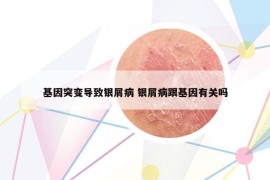 基因突变导致银屑病 银屑病跟基因有关吗