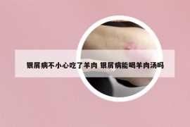 银屑病不小心吃了羊肉 银屑病能喝羊肉汤吗