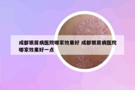 成都银屑病医院哪家效果好 成都银屑病医院哪家效果好一点