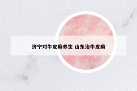 济宁对牛皮癣养生 山东治牛皮癣