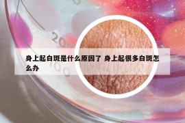 身上起白斑是什么原因了 身上起很多白斑怎么办