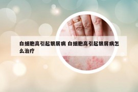 白细胞高引起银屑病 白细胞高引起银屑病怎么治疗