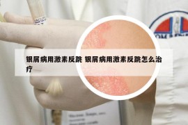 银屑病用激素反跳 银屑病用激素反跳怎么治疗