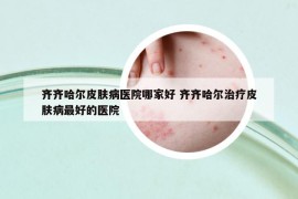 齐齐哈尔皮肤病医院哪家好 齐齐哈尔治疗皮肤病最好的医院