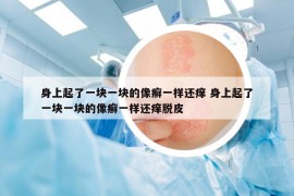 身上起了一块一块的像癣一样还痒 身上起了一块一块的像癣一样还痒脱皮