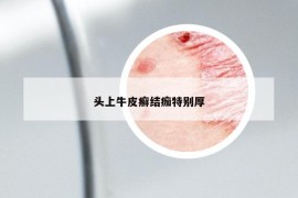 头上牛皮癣结痂特别厚