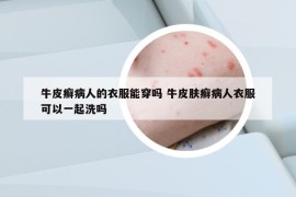 牛皮癣病人的衣服能穿吗 牛皮肤癣病人衣服可以一起洗吗