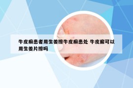 牛皮癣患者用生姜擦牛皮癣患处 牛皮廨可以用生姜片擦吗