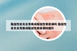 脂溢性皮炎会发展成脂溢性银屑病吗 脂溢性皮炎会发展成脂溢性银屑病吗图片