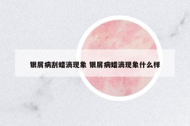 银屑病刮蜡滴现象 银屑病蜡滴现象什么样