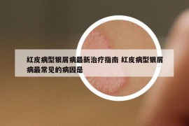 红皮病型银屑病最新治疗指南 红皮病型银屑病最常见的病因是