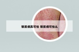 银屑病真可怕 银屑病可怕么