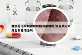 金银花泡水喝对银屑病有帮助吗 银屑病可以用金银花泡澡吗