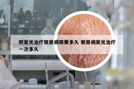 照紫光治疗银屑病需要多久 银屑病紫光治疗一次多久