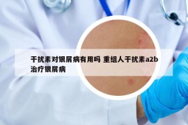 干扰素对银屑病有用吗 重组人干扰素a2b治疗银屑病