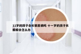 11岁的孩子会长银屑病吗 十一岁的孩子长癣癣会怎么办