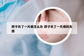 脖子长了一片癣怎么办 脖子长了一片癣的东西