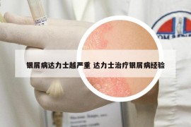 银屑病达力士越严重 达力士治疗银屑病经验