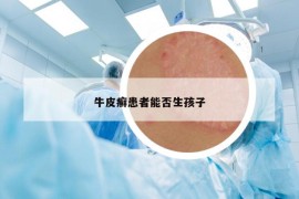 牛皮癣患者能否生孩子