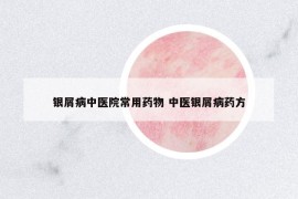 银屑病中医院常用药物 中医银屑病药方