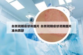 白斑初期症状和图片 白斑初期症状初期图片准向西部