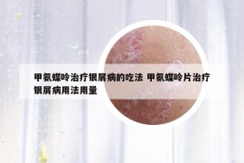 甲氨蝶呤治疗银屑病的吃法 甲氨蝶呤片治疗银屑病用法用量
