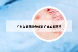 广东白癜风肤色修复 广东白斑医院