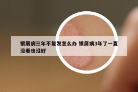 银屑病三年不复发怎么办 银屑病3年了一直没看也没好