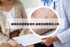 副银屑病需要输液吗 副银屑病需要忌口吗