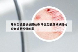 寻常型银屑病病理检查 寻常型银屑病病理检查有诊断价值的是