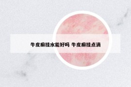 牛皮癣挂水能好吗 牛皮癣挂点滴