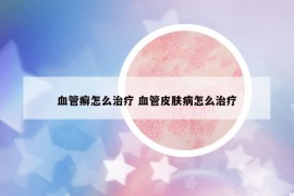 血管癣怎么治疗 血管皮肤病怎么治疗