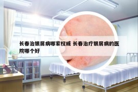 长春治银屑病哪家权威 长春治疗银屑病的医院哪个好
