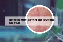 藏研霜皮肤抑菌乳膏的作用 藏研肤宝抑菌霜效果怎么样