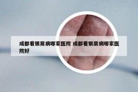 成都看银屑病哪家医院 成都看银屑病哪家医院好