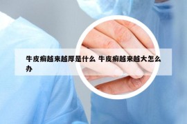 牛皮癣越来越厚是什么 牛皮癣越来越大怎么办