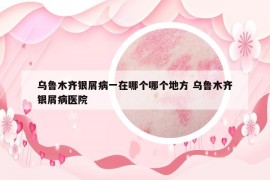 乌鲁木齐银屑病一在哪个哪个地方 乌鲁木齐银屑病医院