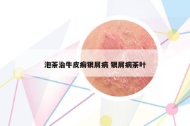 泡茶治牛皮癣银屑病 银屑病茶叶