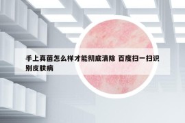 手上真菌怎么样才能彻底清除 百度扫一扫识别皮肤病