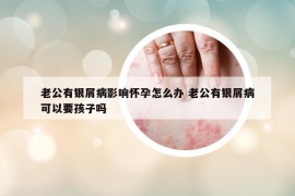 老公有银屑病影响怀孕怎么办 老公有银屑病可以要孩子吗