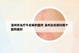温州市治疗牛皮癣的医院 温州治皮肤科哪个医院最好