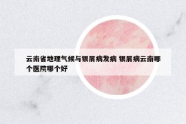 云南省地理气候与银屑病发病 银屑病云南哪个医院哪个好