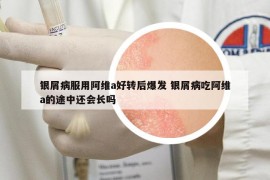 银屑病服用阿维a好转后爆发 银屑病吃阿维a的途中还会长吗