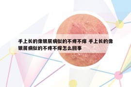 手上长的像银屑病似的不疼不痒 手上长的像银屑病似的不疼不痒怎么回事