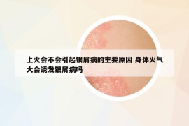 上火会不会引起银屑病的主要原因 身体火气大会诱发银屑病吗