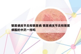 银屑病关节炎和银屑病 银屑病关节炎和银屑病服的中药一样吗