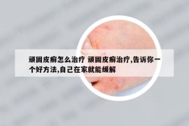 顽固皮癣怎么治疗 顽固皮癣治疗,告诉你一个好方法,自己在家就能缓解